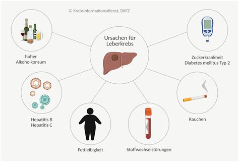 Leberkrebs Ursachen Symptome Und Therapie Dkfz