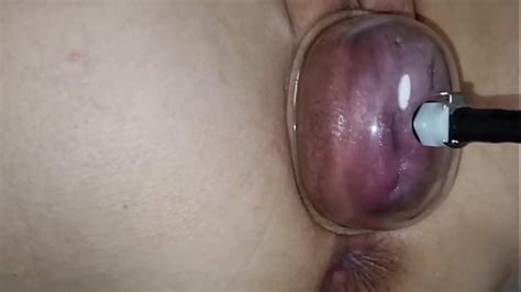 Using A Pussy Pump To Swell My Pussy Lips And My Swollen Vagina Xxx Mobile Porno Videos