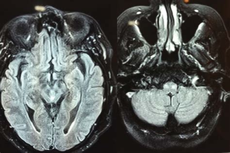 A B Midbrain Ischemia And Bilateral Hypertrophic Olivary Degeneration