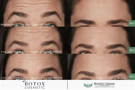 Botox Vs Dermal Fillers Understanding The Differences