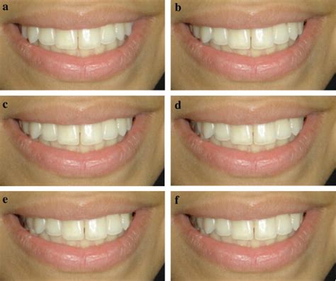 Photographs Showing Alterations To Maxillary Dental Midline In Relation