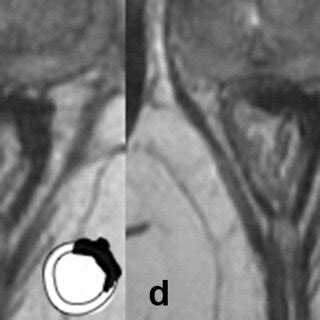 MRI in rectal cancer patients on ‘watch and wait’: patterns of response and their evolution ...