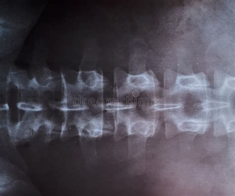 Rayos X De La Columna Vertebral, Columna Vertebral Foto de archivo