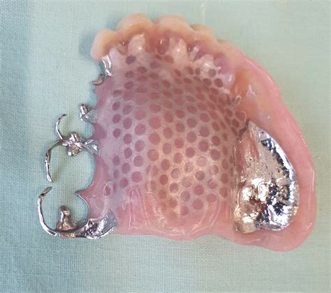 Partial Dentures Plates Northland Prosthodontics Northland