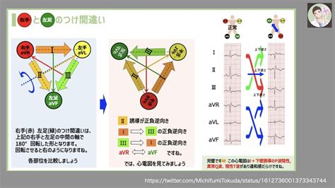 【コラム-141改】：徳田道史先生のtweet集 心電図検定試験対策です。 2023/4/8 版です。 - Cardio2012のECGブログ ...