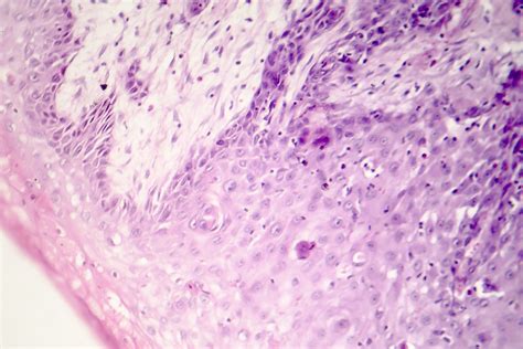 Squamous Cell Carcinoma Of Skin Pictures Squamous Cell Carcinoma Warning Signs And Images