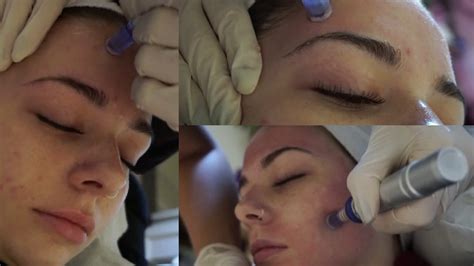 Microneedling Facial Vlog Youtube