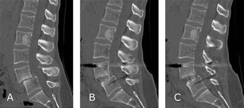 Early Fusion Rates After Direct Lateral Lumbar Interbody Fusion With Bone Morphogenetic Protein