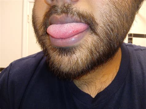 what are these red bumps on tongue? : r/askdentists