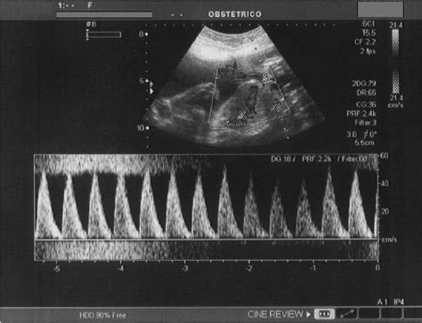 Doppler ultrasound findings. | Download Scientific Diagram