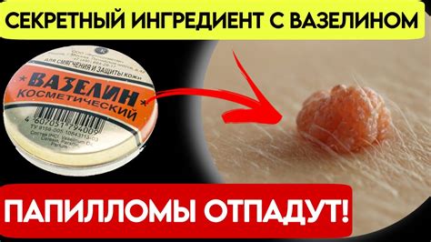 Прощайте папилломы и бородавки: уникальное чудо-средство на все случаи ...