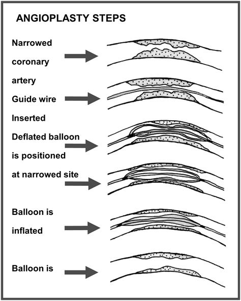 coronary angioplasty   stent implantation fph