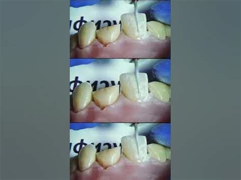 Композитные Блич Виниры. 2-х дневная Практика от Клыка до Клыка - YouTube