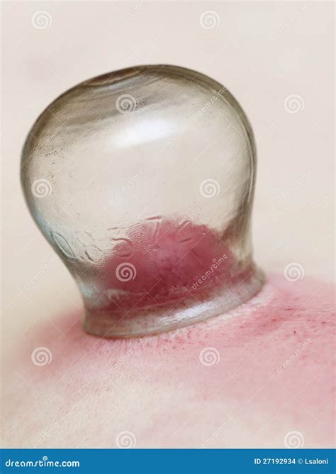 Fire Cupping Treatment To Cup Sb Therapy Woman Stock Photo Image Of