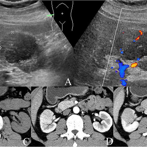 A Longitudinal Grayscale Us Showed A Well Demarcated Round