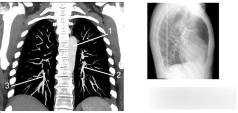 Diagram Of Coronal Contrast Enhanced Chest W Mediastinal Windows 8