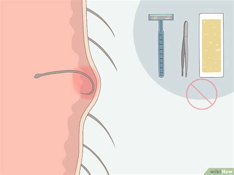 How To Remove Bikini Ingrown Hair