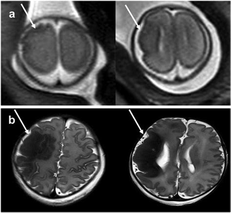 Prenatal And Postnatal Magnetic Resonance Pictures A Irregular