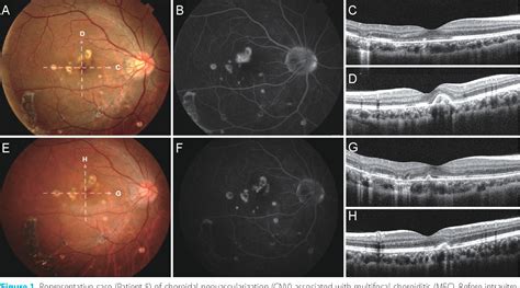 Figure 1 From Intravitreal Bevacizumab Injection For Choroidal