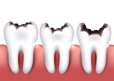 Síntesis de 17 artículos como se ven las caries actualizado