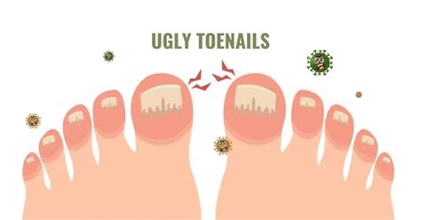 A Comprehensive Guide To Overcoming Ugly Toenails Crispme