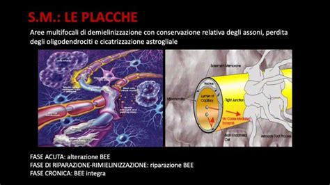 Malattia Degenerativa Della Sostanza Bianca Cause E Trattamenti