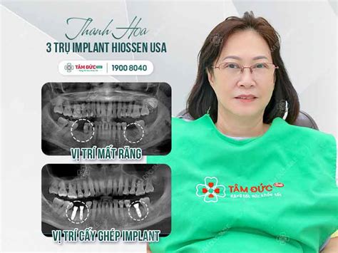 TRỒNG RĂNG TRỤ IMPLANT PHÁP GIÁ BAO NHIÊU TIỀN NÊN TRỒNG RĂNG Ở ĐÂU UY TÍN