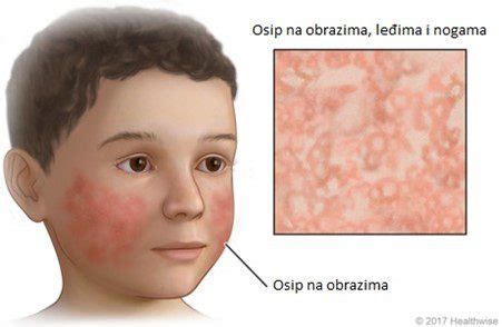 Peta Osipna Bolest Erythema Infectiosum Zzjzks