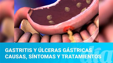 Gastritis Y Lceras G Stricas Causas S Ntomas Y Tratamientos Youtube