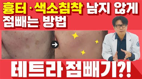 점빼고 흉터 색소침착 생기지 않는 방법 Ft테트라점빼기 Youtube