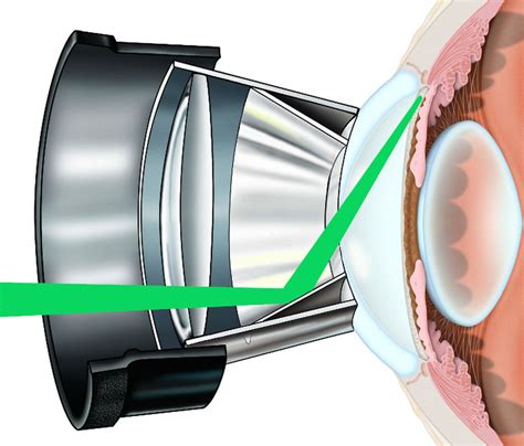 Gallery Glaucoma Associates Of Texas