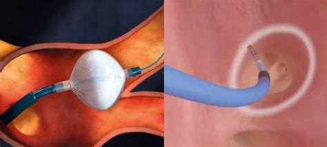 Cryoballoon Or Radiofrequency Ablation For Paroxysmal 41 Off