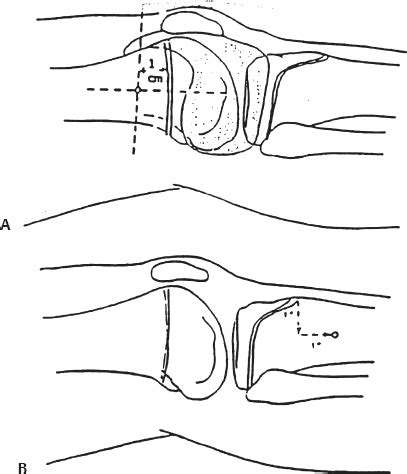 Skeletal Traction Femur Fracture