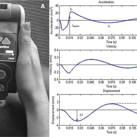 High Density Surface EMG A Multi Channel Surface Electromyography