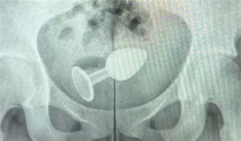 Paciente Internada Ap S Plug Anal Subir Para O Reto M Dico Explica Como Evitar Problemas Ao
