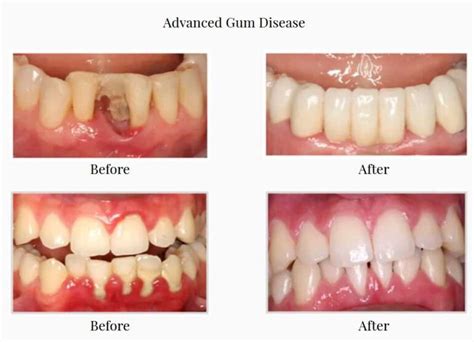 Non-Surgical Treatment of Gum Disease - Alhambra Dental