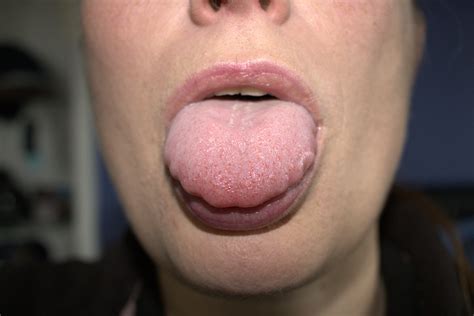 Virus That Causes Bumps On Tongue Printable Templates Free