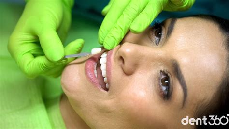 Veneers in der Türkei Istanbul Kosten Beste Klinik