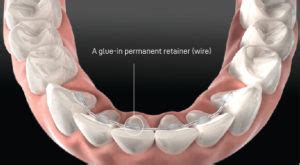 Orthodontic Relapse Teeth On The Move