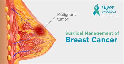 Surgical Management Of Breast Cancer Dr Sreekanth K