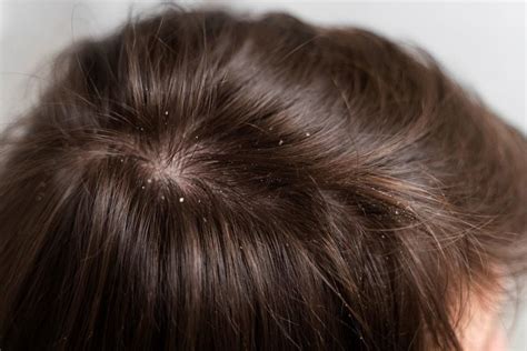 Interpretasyon Ng Panaginip Tungkol Sa Pagkakita Ng Mga Kuto Sa Buhok