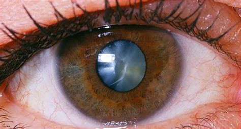 What Causes Halos Around Lights After Cataract Surgery | Shelly Lighting