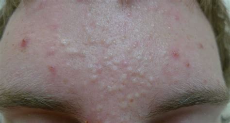 Best Cystic Acne Treatments In Australia Dr Davin Lim