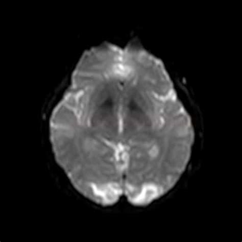 Posterior Reversible Encephalopathy Syndrome (PRES) | STROKE MANUAL