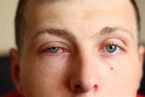 How Does Pink Eye Spread? - Health & Detox & Vitamins