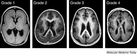 Lissencephaly And Subcortical Band Heterotopia Molecular Basis And