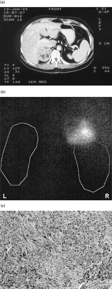 Cortisol Secreting Adrenocortical Carcinoma A Ct Scan Of The Abdomen Download Scientific