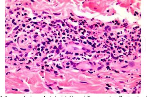 Leukocytoclastic Vasculitis Histology
