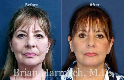 Deep Plane Facelift Cleveland Ohio Dr Harmych