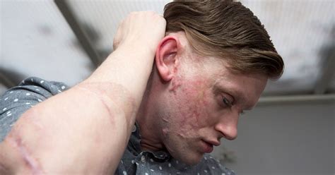 Road Rage Acid Attack Victim Says His Children Have Helped Heal The